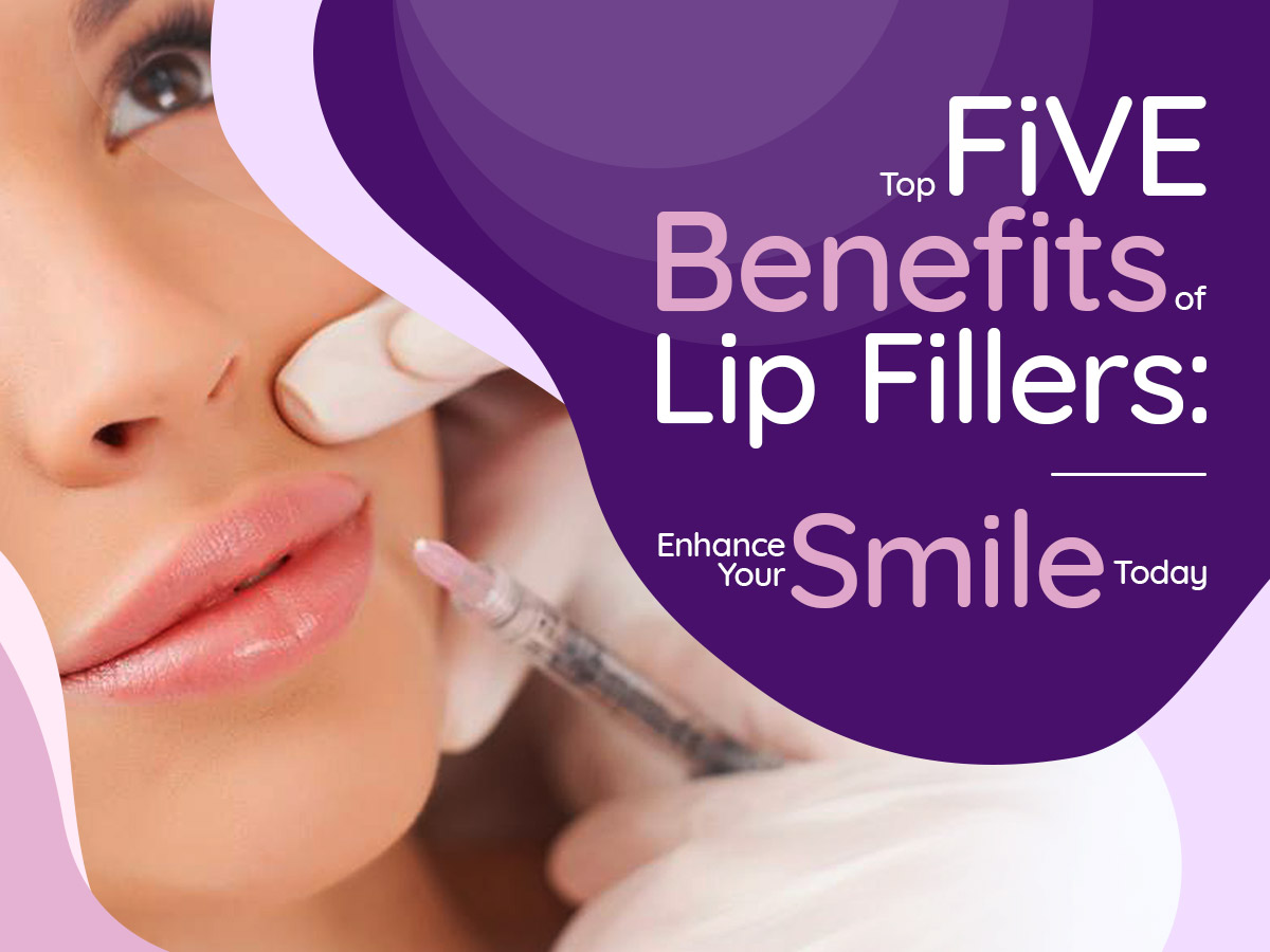 Top 5 Benefits of Lip Fillers